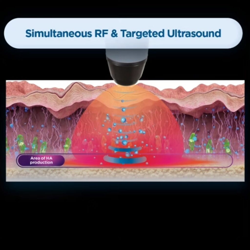 Exion: Remodela tu cuerpo de forma segura y eficaz 4