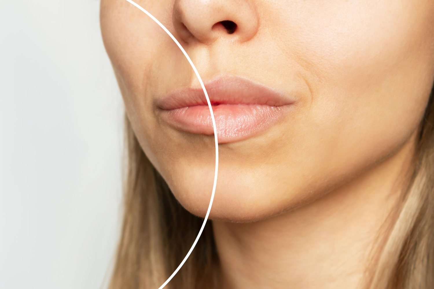 Especialista en aumento de labios en Bilbao