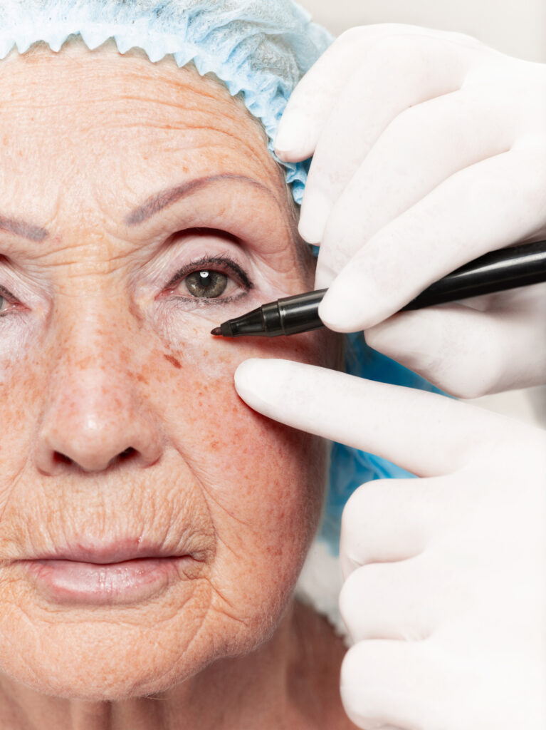 Blefaroplastia 1